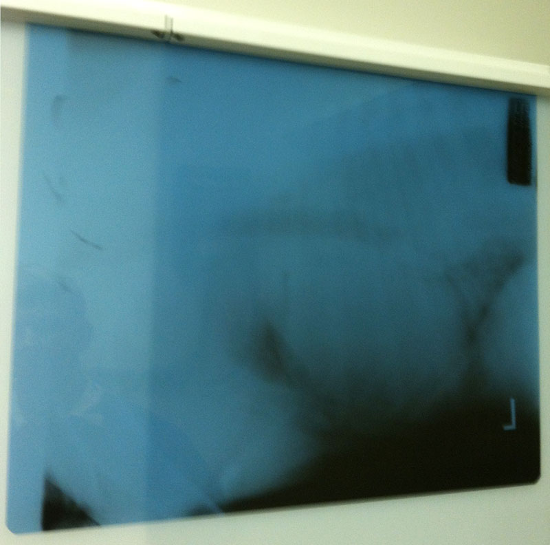 Chest x-ray showing huge cyst